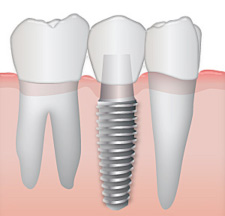 dental implants