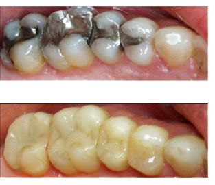 fillings